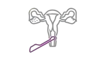 Genix Fertility Care | Baby Conceive Methods in Bhubaneswar, Odisha >> Ovum Retrieval